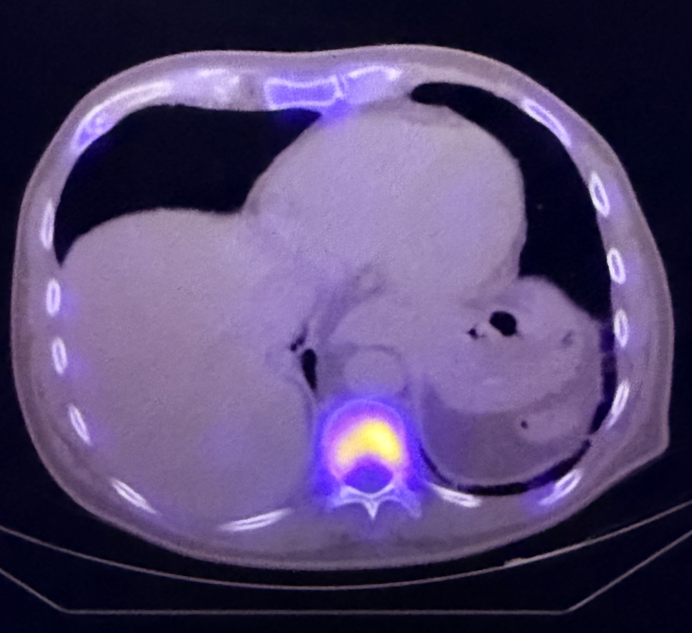 PET/CT example used to illustrate head-and-neck cancer staging